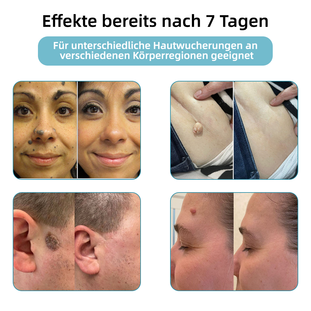 Jasseem® – Neue Version 2025 – Laser-Stift zur schmerzfreien Entfernung von Warzen & Hautflecken 2.0