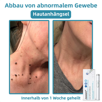 Jasseem® – Neue Version 2025 – Laser-Stift zur schmerzfreien Entfernung von Warzen & Hautflecken 2.0