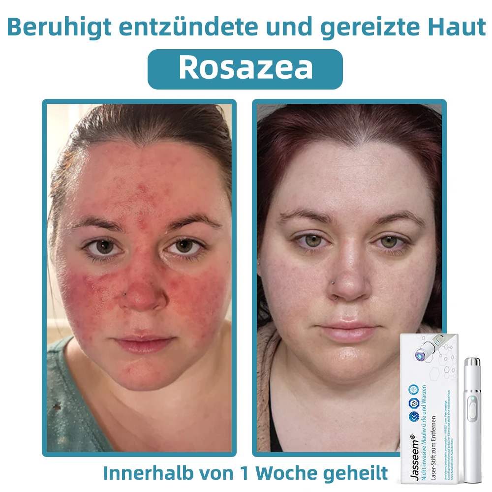 Jasseem® – Neue Version 2025 – Laser-Stift zur schmerzfreien Entfernung von Warzen & Hautflecken 2.0