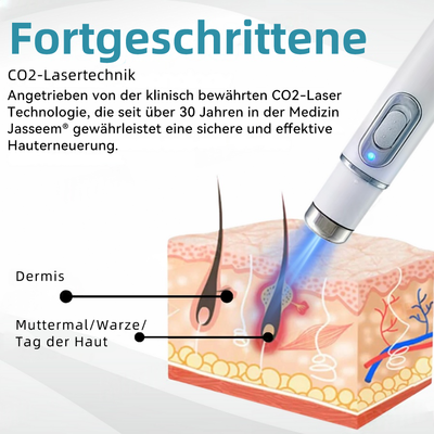 Jasseem® – Neue Version 2025 – Laser-Stift zur schmerzfreien Entfernung von Warzen & Hautflecken 2.0