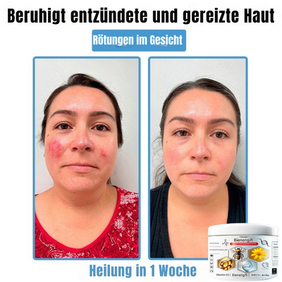 BIENENGIFT® – Multi-Symptom Creme gegen Hautprobleme